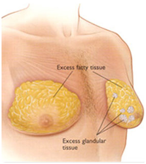 gynecomastia surgery abroad